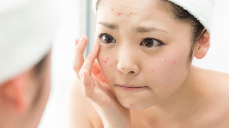 Cách Sử Dụng Thuốc Trị Mụn An Toàn và Hiệu Quả