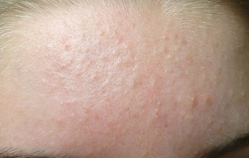skincare tri mun cho da dau 4
